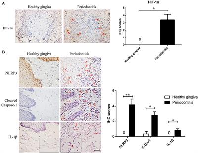 Porphyromonas gingivalis-Derived Lipopolysaccharide Combines Hypoxia to Induce Caspase-1 Activation in Periodontitis